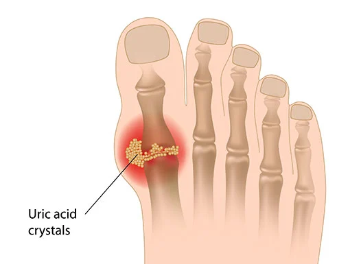 Natural Ways to Control Uric Acid